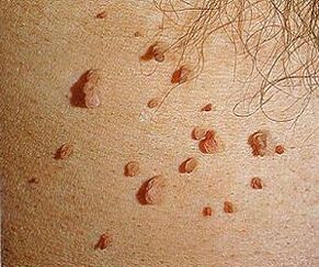 humant papillomvirus på huden
