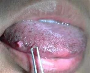 humant papillomvirus på tungan