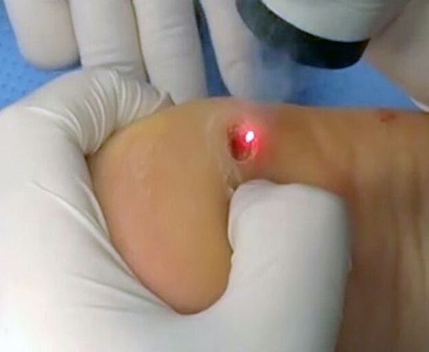 Proceduren för att ta bort vårtor på hälen med hjälp av en laser