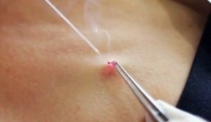 avlägsnande av papillom på kroppen med en laser